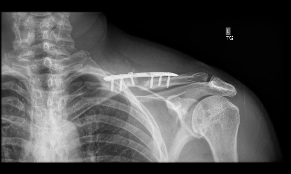An x-ray of Andrew Houlihan's left clavicle. Image: Supplied